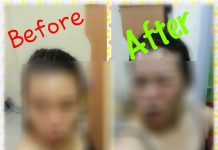 เสียโฉม – ติดเอดส์“ฟิลเลอร์”สวยสังหาร ฉีดแล้วแจ่มๆ แล้วเสี่ยงตาย!